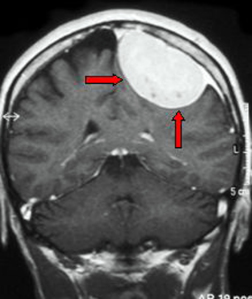 Meningioma della convessità